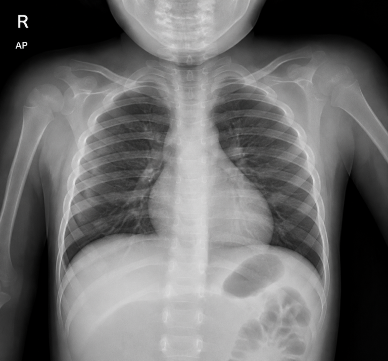 pediatric chest X-ray (radiograph)